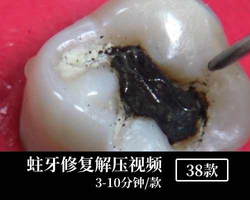 蛀牙修复解压中视频素材
